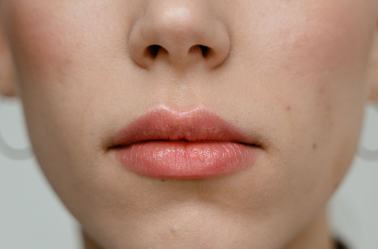 small-bumps-on-lips-fordyce-spots-and-how-to-treat-them-maximum